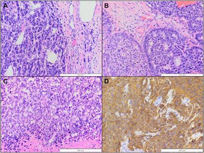 Non-metastatic primary neuroendocrine neoplasms of the breast: a reference cancer center’s experience of a heterogenous entity